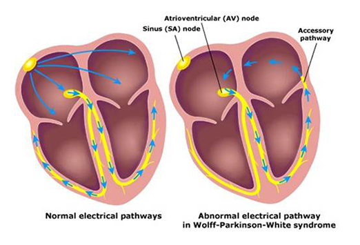图文并茂|当预激遇上房颤_预激综合征_WPW综合征_房颤_医脉通