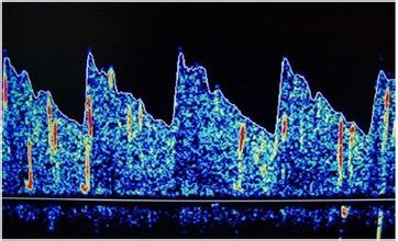 羟基脲能否作为镰状细胞贫血儿童的替代疗法?