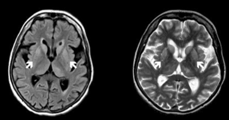 一个神奇的疾病--自身免疫性脑炎几件趣事