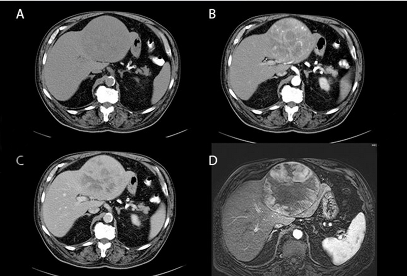 [有图有真相]图解7种常见肝脏肿瘤—恶性篇