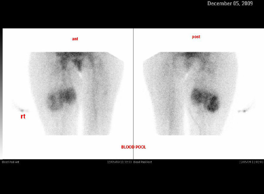 多图:滑膜肉瘤的影像学表现什么样?