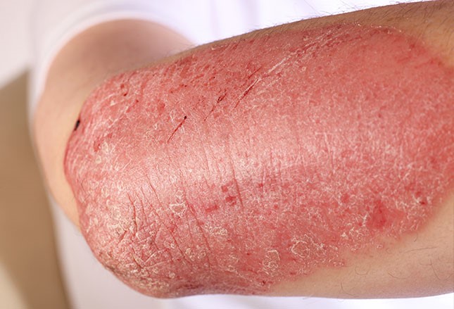 图文并茂:风湿性疾病的皮肤症状之银屑病、白