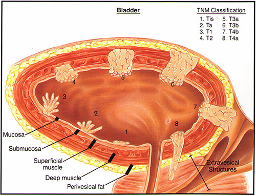 com.au,膀胱解剖和膀胱癌t分期)