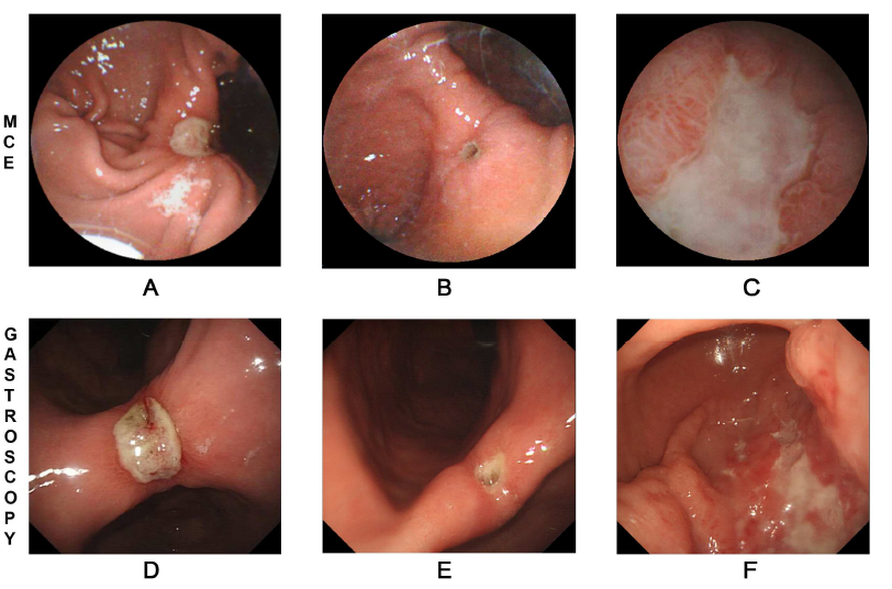 磁控胶囊内镜在胃疾病诊断中的准确性