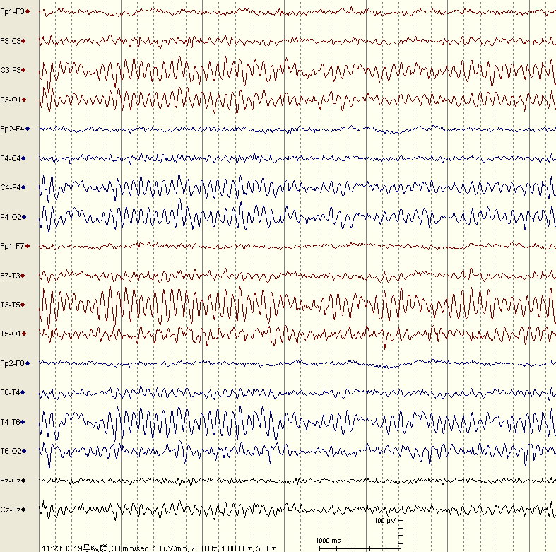 实战图形教你掌握正常成人脑电图