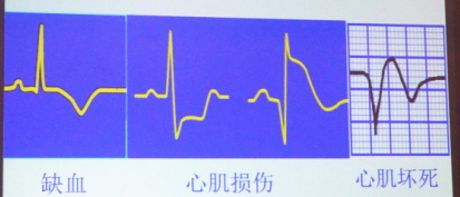 罗心平:急性冠脉综合征的心电图识别与诊断