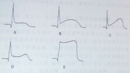 坏死性q波的心电图特征包括:①在r波向量本来就偏小的导联(v1,v2,v3)