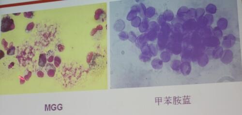 图12为mgg和甲苯胺蓝染色的pcp患者的bal.