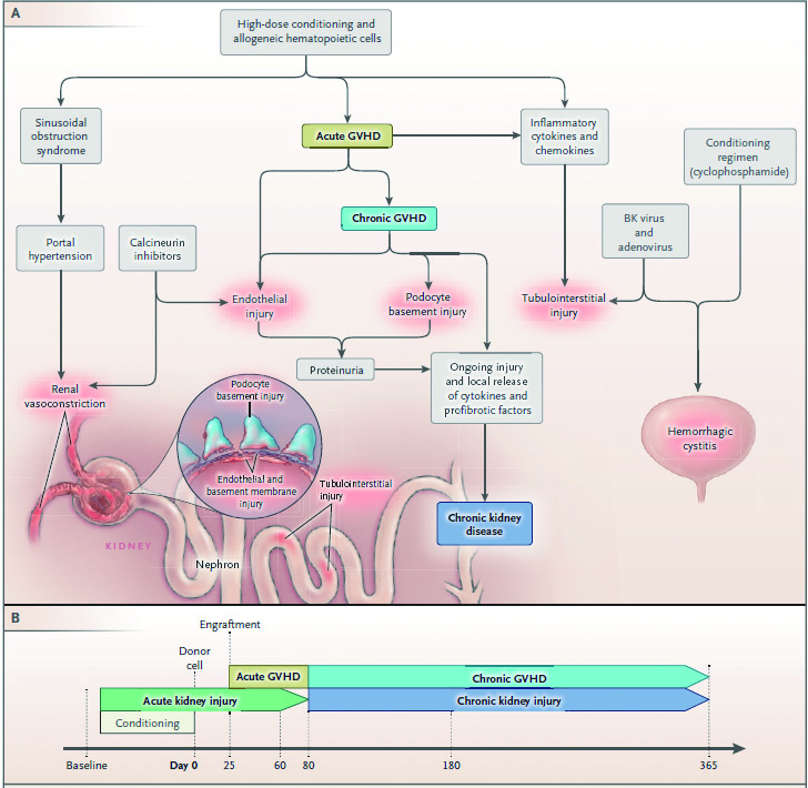 NEJM:造血干细胞移植后肾脏并发症(上)_急性