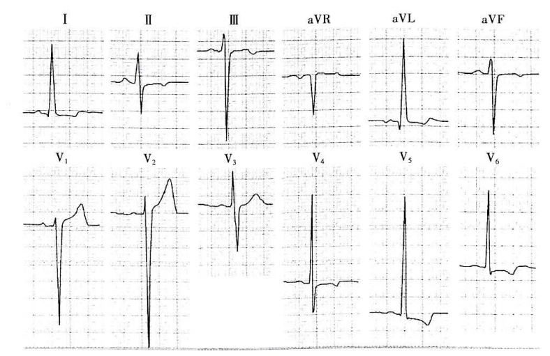 偷偷告诉你心电图中的大哥和小弟_心电图