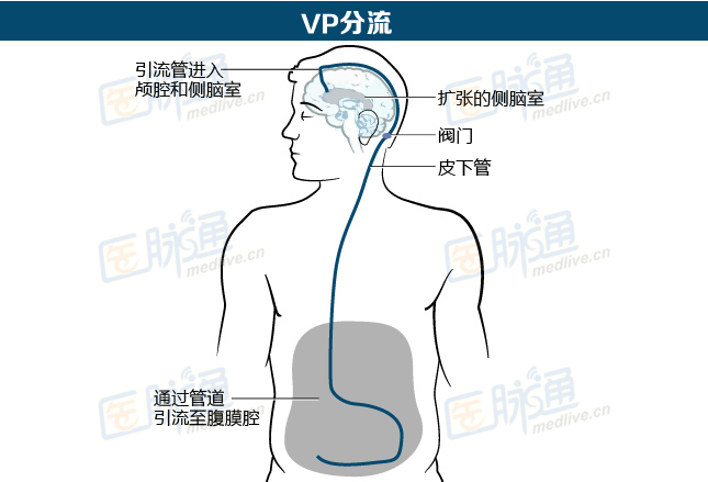 脑部积水如何治疗