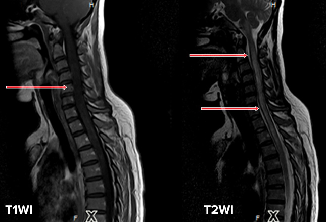 脊髓半切损害综合征最常见于 a.脊柱结核b.髓外硬脊膜内肿瘤c.
