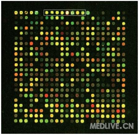 生物芯片技术可准确快速检测出老年痴呆症的风