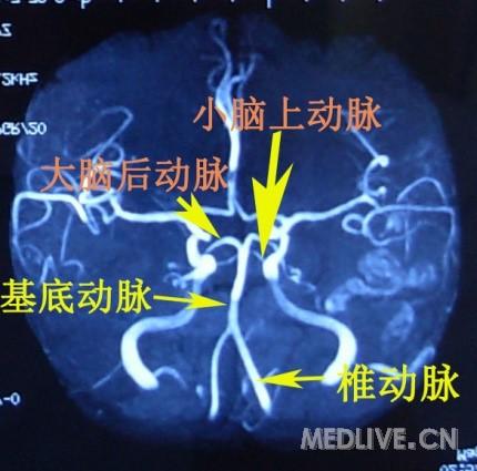 手把手教会阅读头mra和cta之后循环 willis环