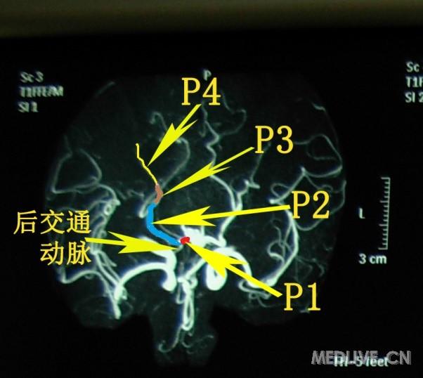 手把手教会阅读头mra和cta之后循环 willis环