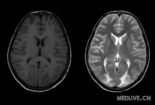脑白质病诊治:边答题,边学习_脑白质病_多发性