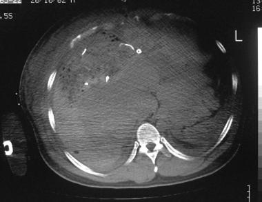 肝外伤影像学之:计算机断层扫描(CT)_肝外伤_