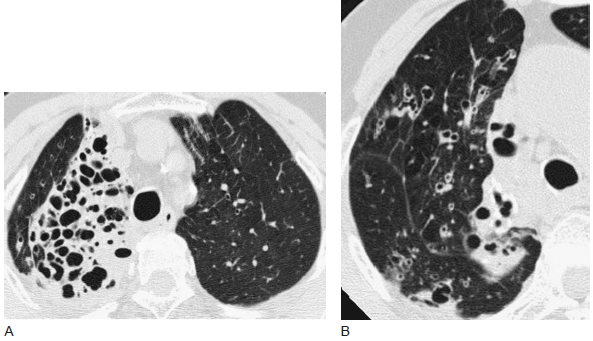 CT 区分支气管扩张的原因