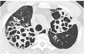 CT 区分支气管扩张的原因