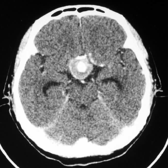 多图|颅内动脉瘤的影像学诊断