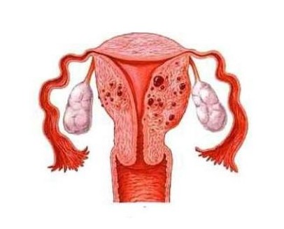 子宫腺肌病重要指南和诊治流程_子宫腺肌病_