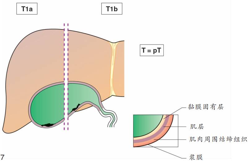 胆囊癌TNM分期图文解析