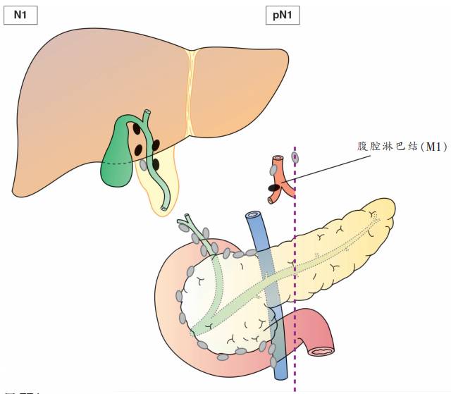 胆囊癌TNM分期图文解析