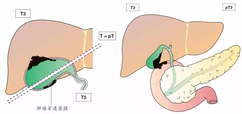 胆囊癌TNM分期图文解析