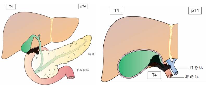 胆囊癌TNM分期图文解析