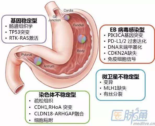 [专家解读]胃癌分型及晚期患者的系统治疗_胃