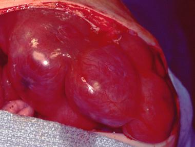 儿童肝脏肿瘤之:良性肿瘤概览