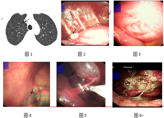 内科胸腔镜氩气刀治疗难治性气胸胸膜下肺大疱疗效观察