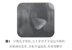 弯根牙的临床综合治疗及正畸早期矫治的可能性