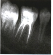 儿童恒牙根管治疗中出现皮下气肿一例