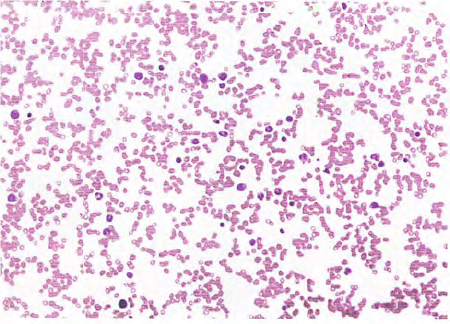 不能不知的骨髓涂片结果分析(上)