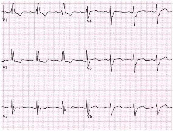 束支、分支传导阻滞:心电图表现及临床意义