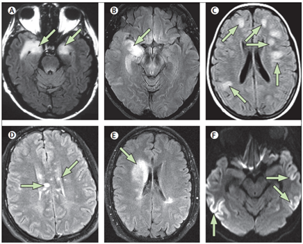 一文详解自身免疫性脑炎的影像学表现