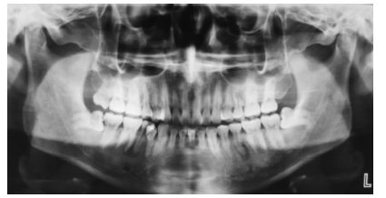 多发多病程前磨牙畸形中央尖1例