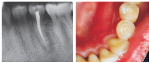 多发多病程前磨牙畸形中央尖1例