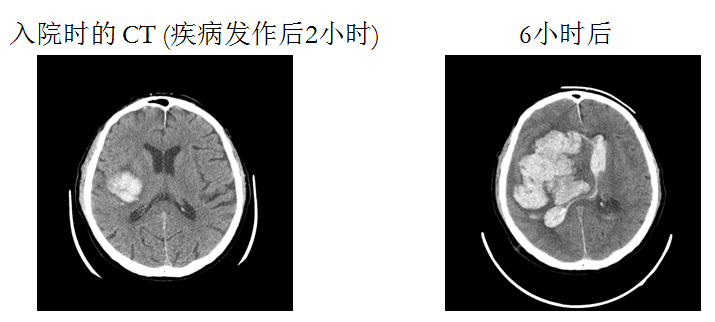 脑出血病人口服药_脑出血病人图片