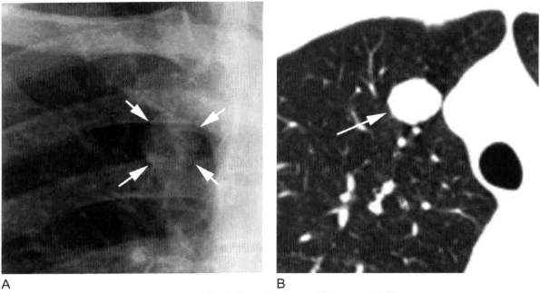 孤立性肺结节良性 vs 恶性的影像学评估(多图)