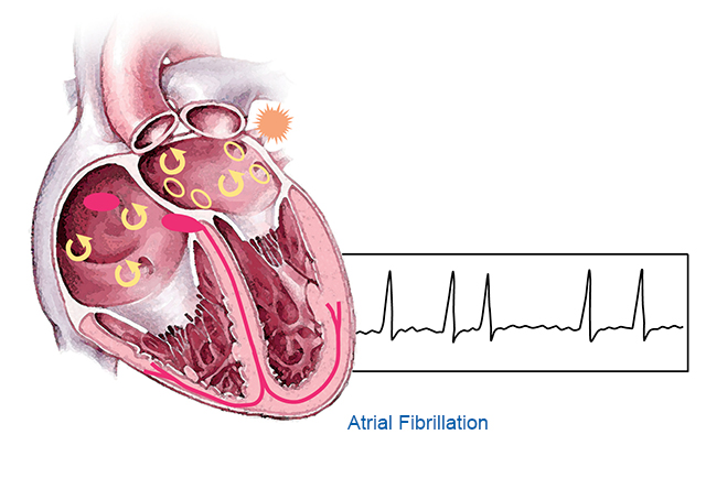 项研究支持NOAC用于房颤合并瓣膜性心脏病患