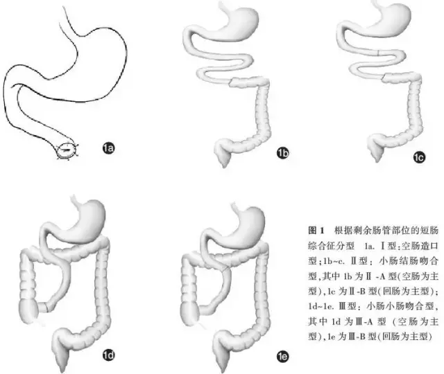 肠吻合型,小肠小肠吻合型可根据剩余小肠是空肠还是回肠为主分为2个亚