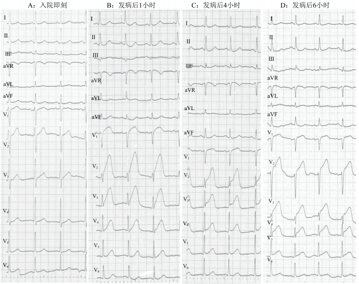 st段抬高型心肌梗死的心电图诊断