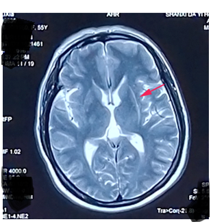 神经影像:壳核裂隙征你真的会吗?_多系统萎缩