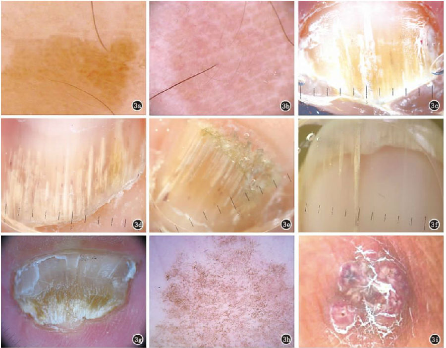 感染性和寄生虫性皮肤病的皮肤镜诊断专家共识