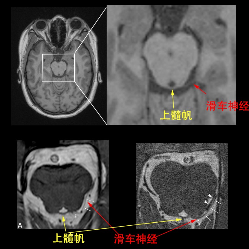 简单又不简单的滑车神经