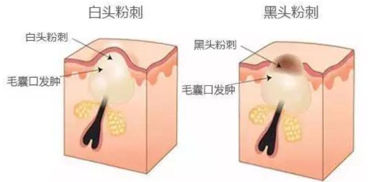 粉刺露去黑头 14949424735884.jpg