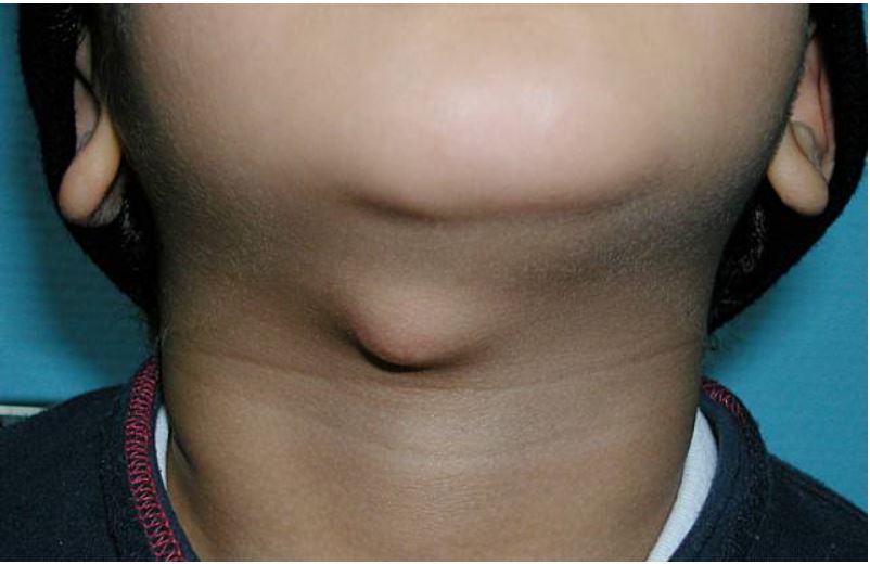 甲状舌骨导管囊肿临床表现