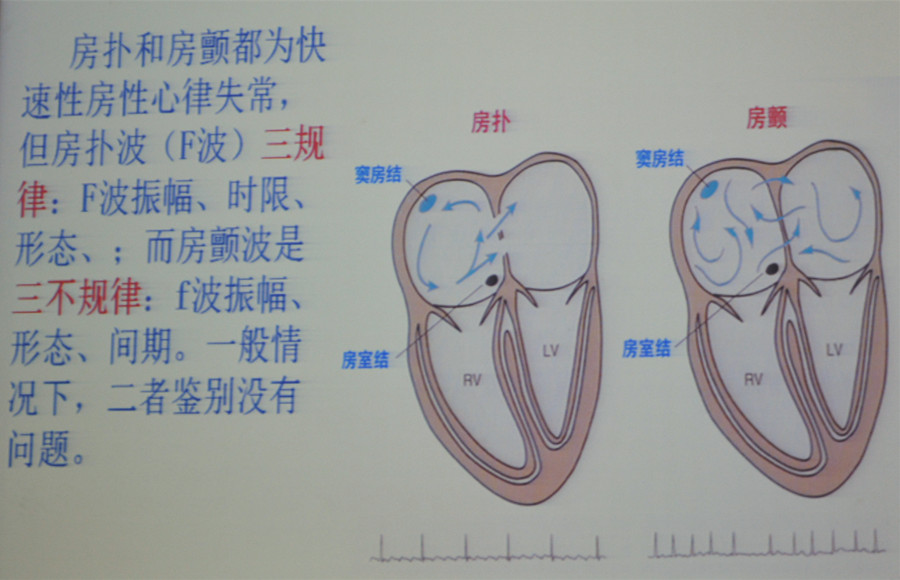 房扑房颤典型心电图特点和发生机理比较